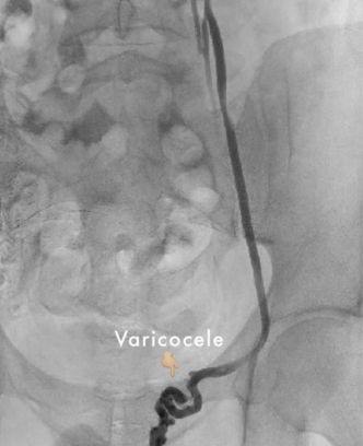 Advanced and effective varicocele treatment in Hyderabad, offered by expert specialists at Dev Hospitals for optimal results.